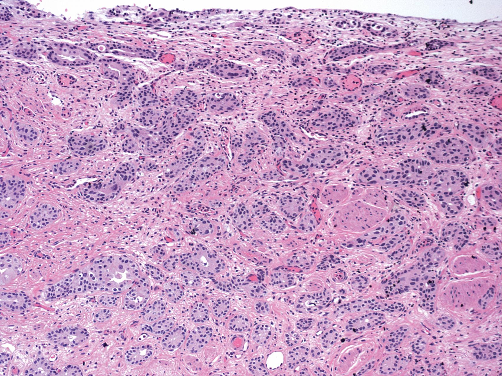 Figure 10.15, Infiltrating urothelial carcinoma, nested variant.