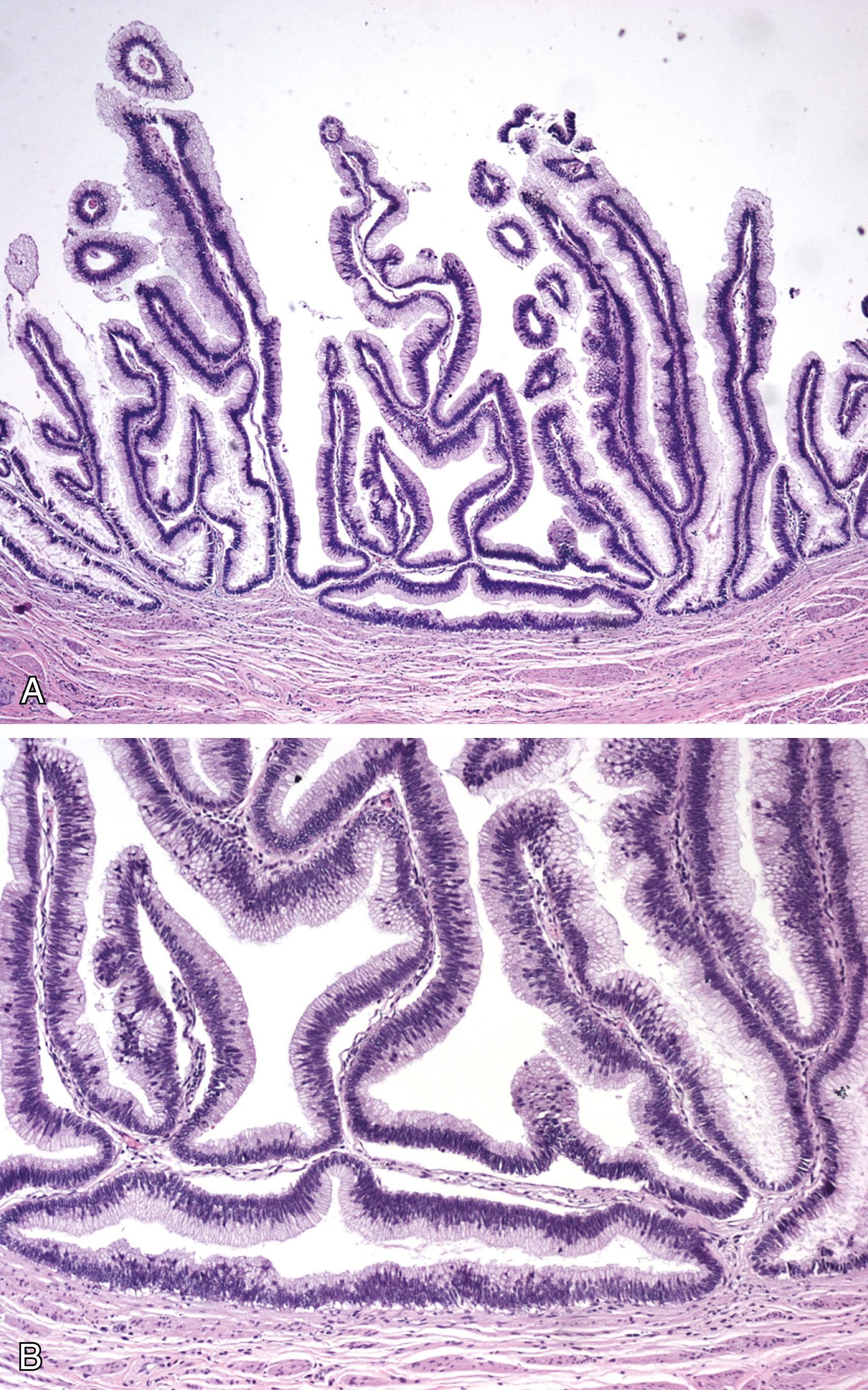 Figure 10.17, A, Villous adenoma. Neoplasm with blunt finger-like papillary architecture with central fibrovascular core, lined by pseudostratified columnar epithelium. B, Villous adenoma. Epithelial cells display nuclear stratification, crowding, hyperchromasia, and occasional prominent nucleoli.