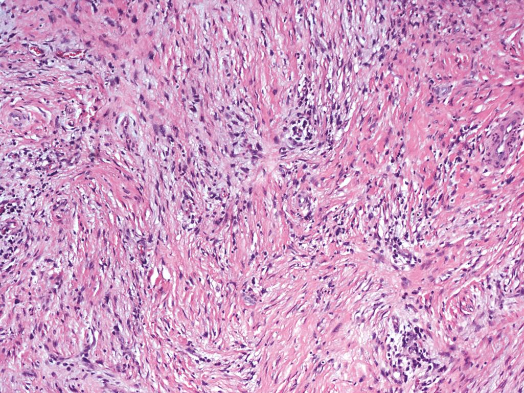 Figure 10.18, Inflammatory myofibroblastic tumor.