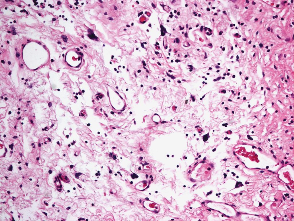 Figure 10.3, Giant Cell Cystitis.