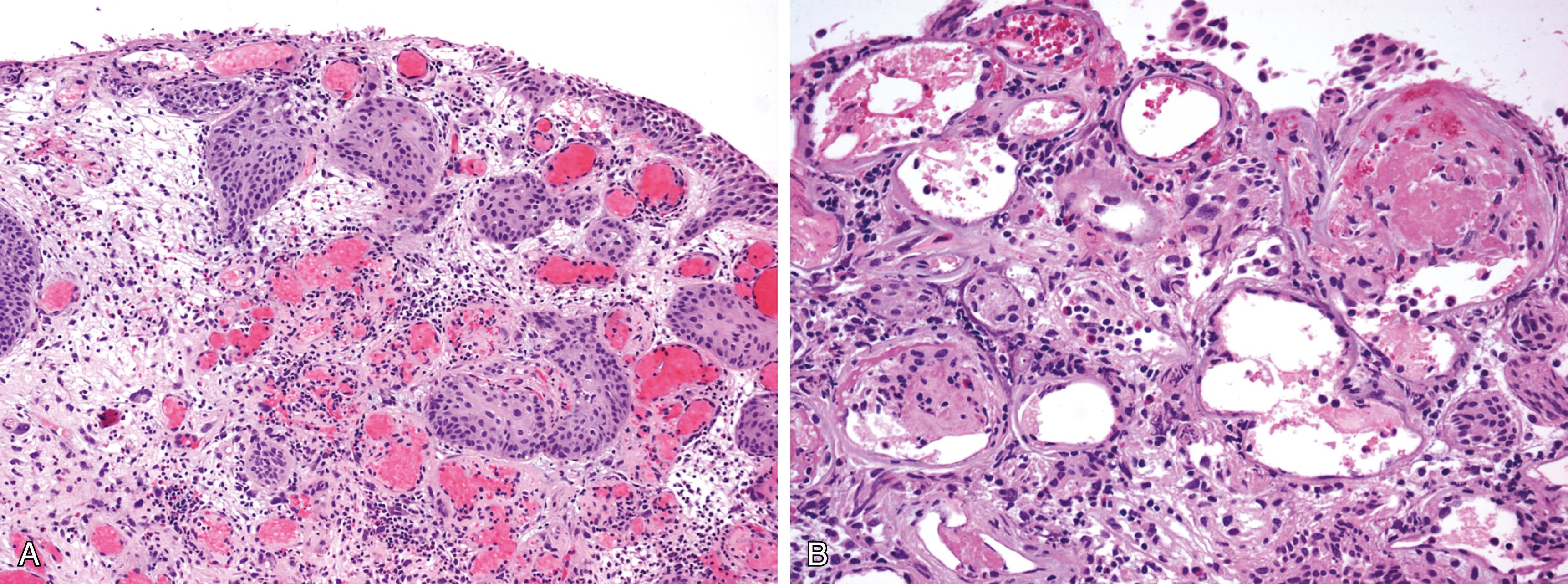 Figure 10.4, A, Radiation cystitis. Lamina propria shows edema, hyperemia, and thickened mucosal folds. The urothelium shows superficial ulceration and atypical cytologic features. The stroma contains extravasated erythrocytes, inflammation, and occasional bizarre multinucleated giant cells. B, Radiation cystitis. Late changes include superficial ulceration and dilated blood vessels with fibrinous exudate.