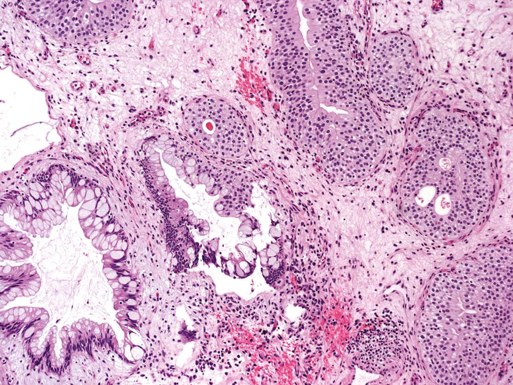 Figure 10.5, Cystitis Cystica et Glandularis.