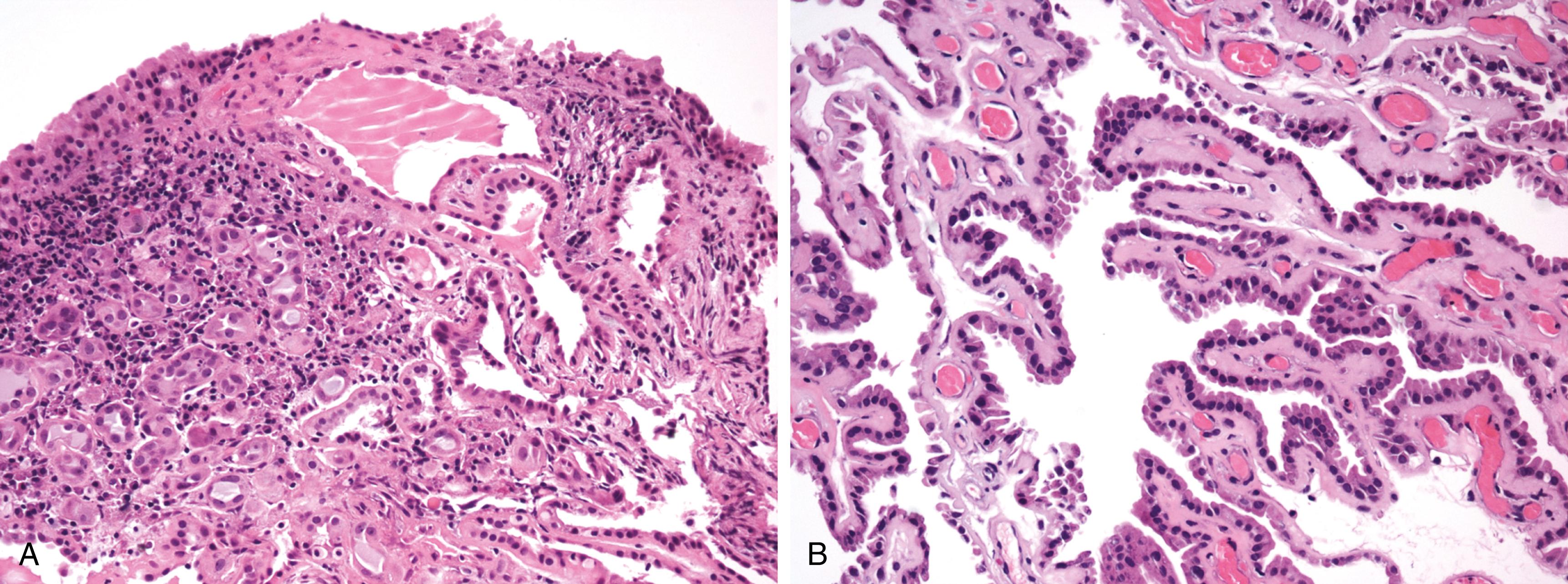 Figure 10.6, A, Nephrogenic adenoma. Proliferation of small tubules lined by cuboidal epithelium. No mitotic activity or nuclear pleomorphism are noted. Tubules are often surrounded by a layer of hyalinized basement membrane. Pale eosinophilic secretions are often found within the tubules. B, Nephrogenic adenoma. Papillary fronds lined by cuboidal eosinophilic cells with occasional “hobnail” features.