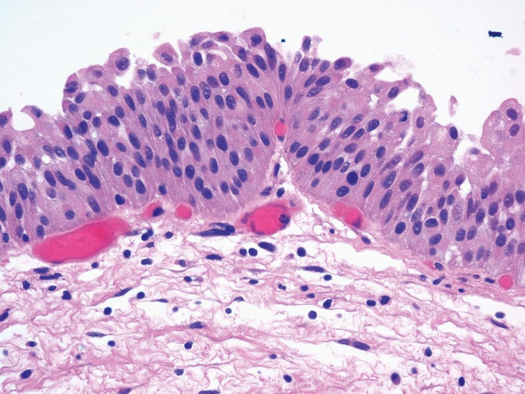 Figure 10.7, Urothelial Dysplasia.