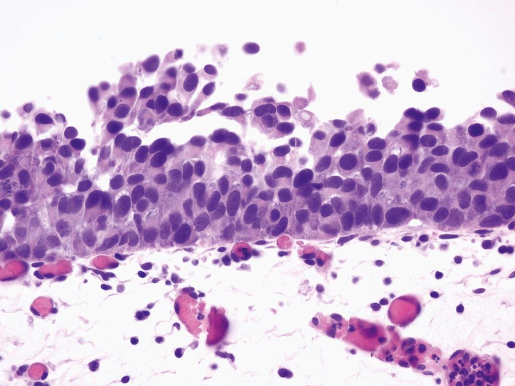 Figure 10.8, Urothelial Carcinoma In Situ.