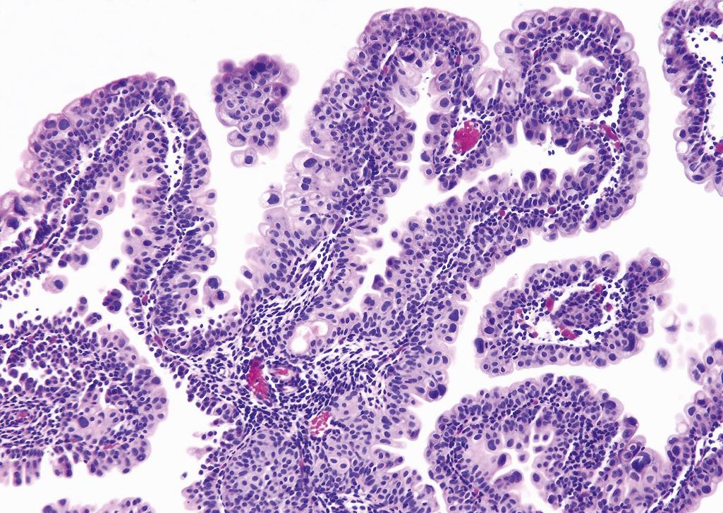 Figure 10.9, Urothelial Papilloma.