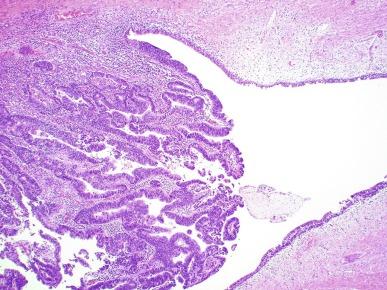 Fig. 11.3, Adenocarcinoma arising in a urethral diverticulum.