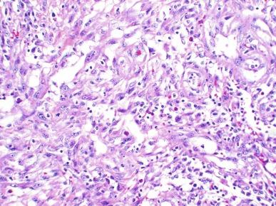 Fig. 11.6, Pseudosarcomatous fibromyxoid lesion (Postoperative spindle cell nodule).