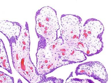 Fig. 11.7, Polypoid urethritis.