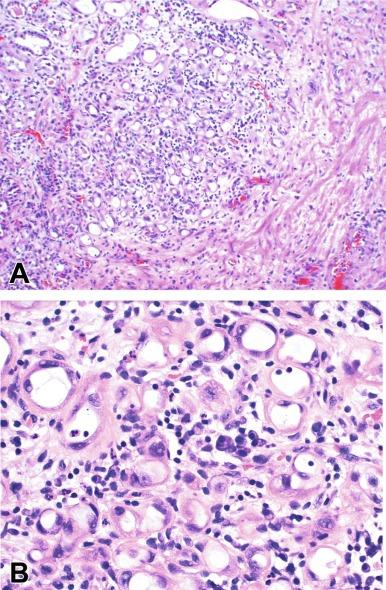 Fig. 11.8, Nephrogenic adenoma.