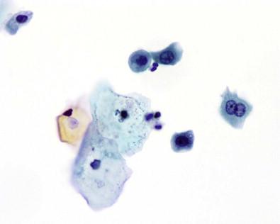 Figure 15-1, Urothelial and squamous cells in normal voided urine. Cytospin preparation (Papanicolaou, ×LP).