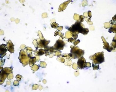 Figure 15-12, Birefringent uric acid crystals in urine (Diff-Quik, ×MP).