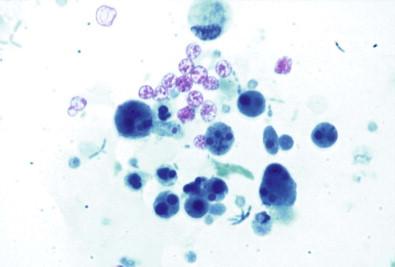 Figure 15-14, Intracytoplasmic inclusions are present in degenerating urothelial cells in cystitis (Papanicolaou, ×HP).