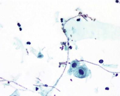 Figure 15-15, Candida spp. in voided urine (Papanicolaou, ×MP).