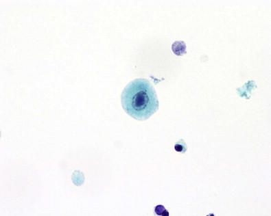 Figure 15-16, CMV-infected cells with large eosinophilic intranuclear inclusion surrounded by clear halo (Papanicolaou, ×MP).