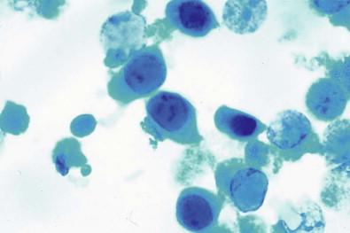 Figure 15-17, Polyomavirus-infected cells with large intranuclear homogeneous inclusions (Papanicolaou, ×HP).