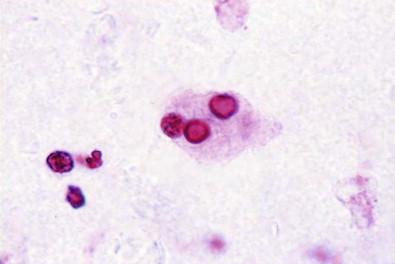 Figure 15-18, Histiocyte-containing intracytoplasmic laminated inclusions consistent with malakoplakia (H&E, ×HP).
