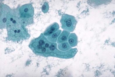 Figure 15-4, Superficial umbrella cells, with a multinucleated cell in an umbrella configuration (Papanicolaou, ×HP).