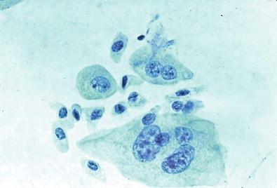 Figure 15-5, Large superficial umbrella and smaller pyramidal or basal cells. Some of the superficial cells are multinucleated and contain nucleoli (Papanicolaou, ×HP).