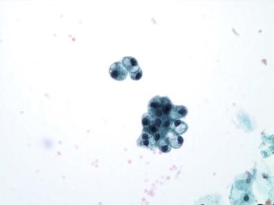 Figure 15-6, Urothelial cells with prominently vacuolated cytoplasm (Papanicolaou, ×MP).