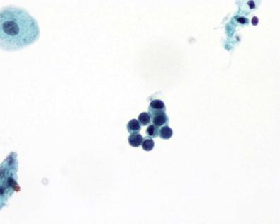 Figure 15-7, Renal tubular epithelial cells. The cells are of a size similar to that of immature urothelial cells and have uniform, round nuclei (Papanicolaou, ×HP).