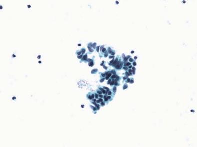 Figure 15-8, Columnar cells in voided urine (Papanicolaou, ×MP).