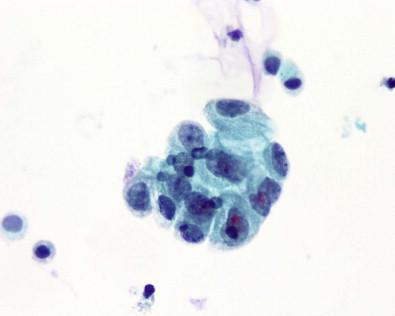 Figure 15-9, Degenerated atypical urothelial cells showing slight anisonucleosis and bland chromatin in bladder catheterized specimen (Papanicolaou, ×HP).