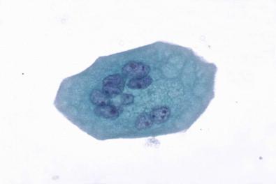 Figure 15-10, A large multinucleated urothelial cell of the type seen most commonly in ureteral and pelvic washings (Papanicolaou, ×MP).