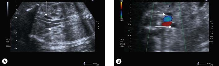 FIGURE 18-10, (A and B) Normal fetal ureters (arrows) measuring less than 1–2 mm. (A) Coronal plane; (B) transverse plane.