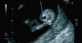 FIGURE 18-11, The fetal bladder (arrow) can be identified from 11–12 weeks' gestation.