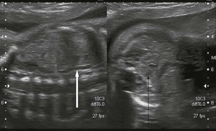 FIGURE 18-13, When the renal fossa is empty either due to ectopia or agenesis the adrenal glands flatten out to fill the space left by the absent kidney: ‘the lying down adrenal sign’ (white arrow). The renal fossa was empty with the kidney located in the pelvis (black arrow).