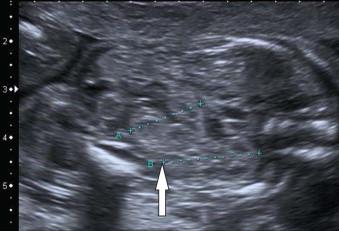 FIGURE 18-14, Crossed renal ectopia, most of the renal tissue lies entirely on the same side on the abdomen.