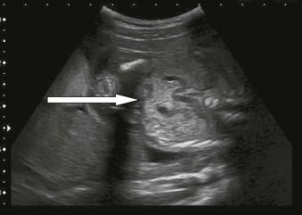 FIGURE 18-15, A horseshoe kidney is best demonstrated on the coronal scan when renal tissue will be seen crossing the midline (arrow).