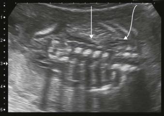 FIGURE 18-16, In unilateral renal agenesis, one kidney is absent. Empty renal fossa with a lying down adrenal gland (arrow).