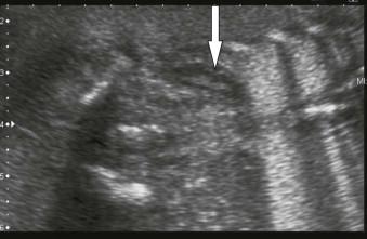 FIGURE 18-17, Bilateral renal agenesis: both kidneys are absent and the adrenal glands assume a discoid shape and move laterally and inferiorly (arrow). Note the anhydramnios.