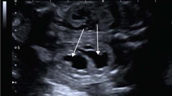 FIGURE 18-19, Duplex kidney: two separate non-communicating renal pelvices are seen (arrows).