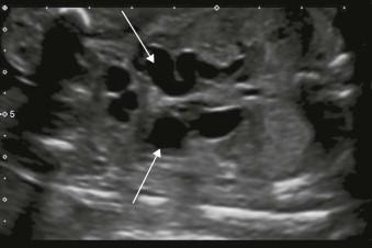 FIGURE 18-20, Dilated ureters (arrows).