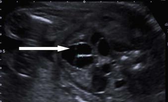 FIGURE 18-21, Cystic structures in the bladder representing ureterocoeles (arrow).