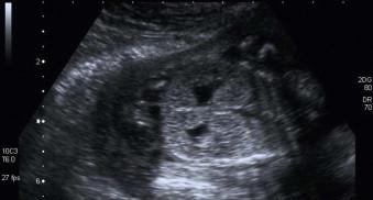 FIGURE 18-22, Non-specific renal dysplasia: the renal parenchyma is much more echogenic than normal, with loss of normal corticomedullary differentiation.