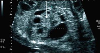 FIGURE 18-24, In a MCDK the parenchymal tissue between the cysts is often hyperechogenic (arrow).