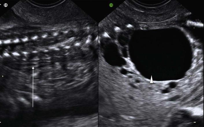 FIGURE 18-25, A very typical MCDK (arrowhead) with contralateral renal agenesis: lying down adrenal gland (arrow).