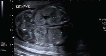 FIGURE 18-26, In autosomal recessive polycystic kidney disease, the kidneys are markedly enlarged and the renal parenchyma is very echogenic.