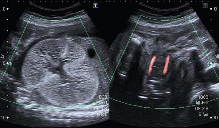 FIGURE 18-29, In autosomal recessive polycystic kidney disease, there will be a gradual loss of bladder visualization.