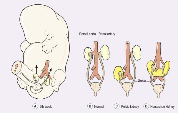 FIGURE 18-4, Normal and abnormal ascent of the kidneys. (A) The metanephros ascends from the sacral region to the definitive lumbar position between the 6th and 9th weeks. (B) Normal. (C) A kidney may fail to ascend resulting in a pelvic kidney. (D) If the inferior poles make contact and fuse, the result is a horseshoe kidney.