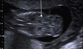 FIGURE 18-7, Hyperechoic fetal kidneys at 13 weeks (arrow).