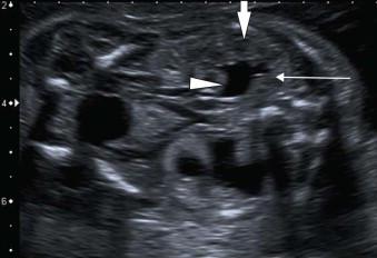 FIGURE 18-8, Between 18 and 24 weeks’ gestation, the echogenic renal cortex (line arrow) is distinguishable from the hypoechogenic medulla (block arrow) and the sonolucent pelvis (arrowhead) can be readily vizualized. Compare with the lower abnormal renal anatomy.