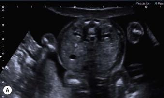 FIGURE 18-9, (A) The normal appearance of the fetal renal pelvis at 20 weeks.