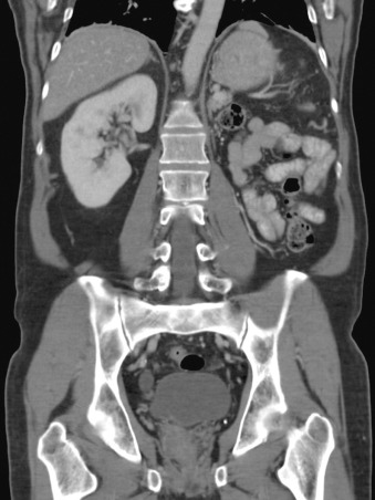 Figure 69-1, Coronal reformatted computed tomography image shows left renal agenesis and compensatory hypertrophy of the right kidney.