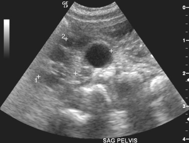 Figure 69-11, Sagittal ultrasound image shows a small echogenic kidney with a peripherally oriented cyst in an infant with proven multicystic dysplastic kidney.