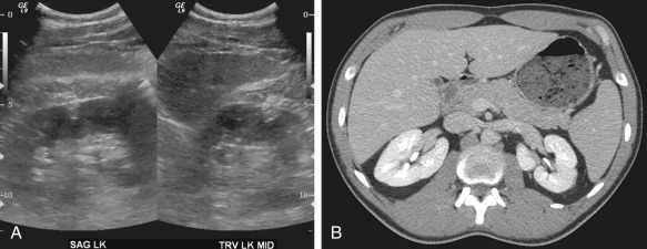 Figure 69-3, A, Sagittal and transverse ultrasound images showed an echogenic band in the renal cortex that does not appear to extend to the renal sinus. B, Axial computed tomography image confirmed extension to the renal sinus consistent with a junctional parenchymal defect.